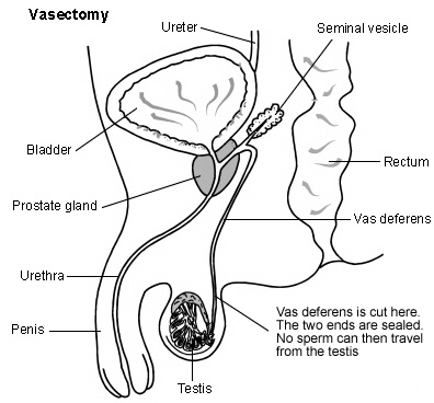 Vasectomy pains 24 hours after the procedure (part 2) 